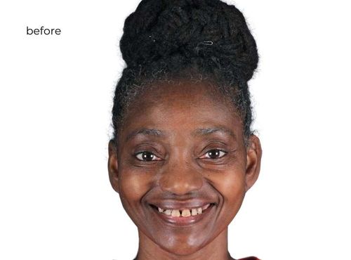 Dental Implants In Phoenix AZ Permanent Teeth In 24 Hrs dental-implants-in-phoenix-az-permanent-teeth-in-24-hrs